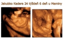 U maminy v brušku - 3D ultrazvuk